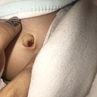 宝宝45天了，肚脐里有一个小红球球，有懂的宝妈吗？有事没？