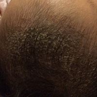 请问宝宝头皮这样有什么好方法？用香油抹了洗，越洗越多呢