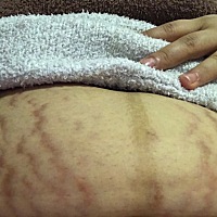 我的皮肤特别紧，生完孩子成这样了，还能恢复好吗？ 是