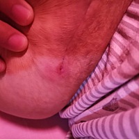 剖腹产26天，有宝妈有这样的情况吗？？刀口的最右边裂开了一点，还流水？？？？