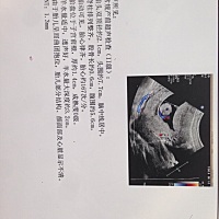 二胎了，都不放在心上了，今天第一次做了nt检查，不知姐妹们有会看这个的吗？看的出来是男孩还是女孩啊？