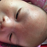 这脸上起的 反反复复的。有什么好办法吗