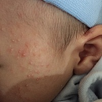 宝宝脸上起湿疹，怎么办？宝宝喝母乳，喝母乳直接睡着，说明他饱了吗？