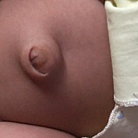 这是不是脐疝，有人说会自愈，是真的吗？不需要治疗吗？