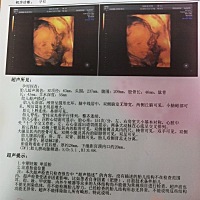 谁能帮帮看看男孩还是女孩。我胎盘低。太夫让注意。有类似这种情况的吗？