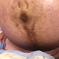 生之前 生以后 双胞胎肚子是这样的吗？感觉整个肚子被毁了.这个黑色的以后不知道能不能自动消失.为了生...