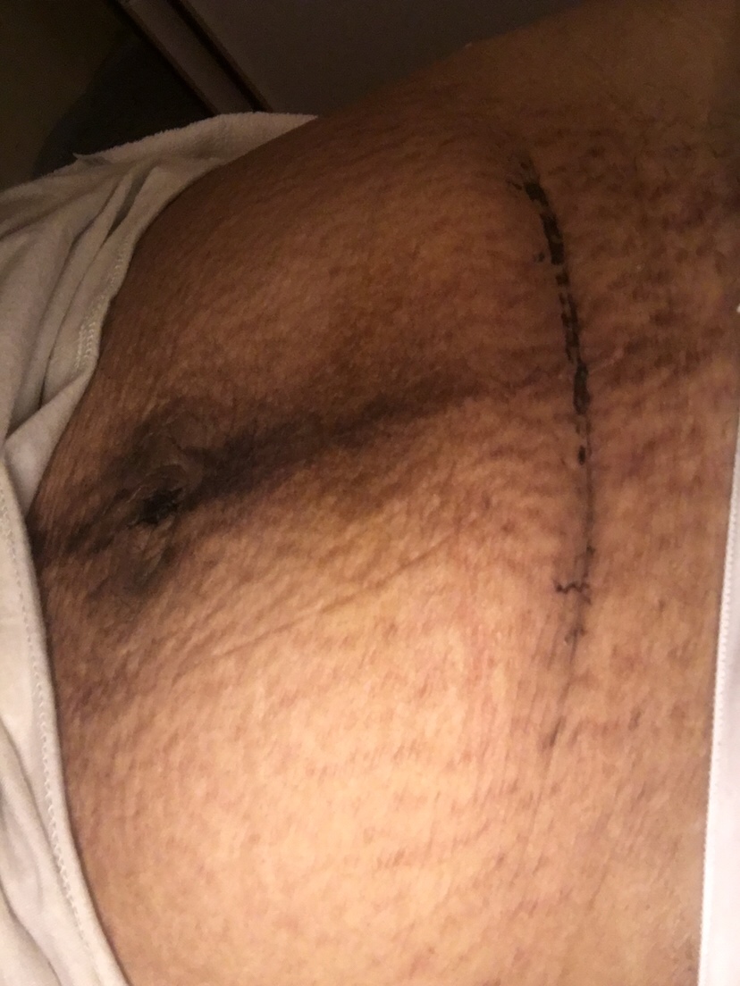 双胞胎肚子是这样的吗？感觉整个肚子被毁了.这个黑色的以后不知道能不能自动消失.为了生孩子付出太多了……