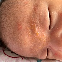 看着好心疼，这是湿疹吗？宝妈们有没有遇到过？有什么好办法吗？