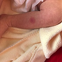 有没有知道这是什么疙瘩？摸了药膏，好了，但还是会反复在起