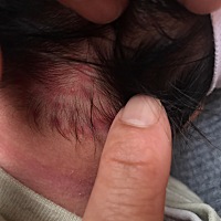 刚出生几天就长这个红疹一样的东西是什么问题？？这个是胎记吗？26天了一直不散！也不是疙瘩！也不热！...