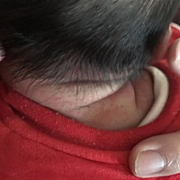 请我我女儿后脖子长得是不是湿疹？？？知道的好心帮帮忙在线等去求告知谢谢谢谢