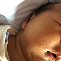 宝宝脸上这是什么啊  天天擦润肤霜没用，不是湿疹吗？