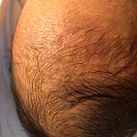 宝宝头上有这样结痂一样的东西 去店里洗澡说10个有9个宝贝有，需不需要去看看啊？