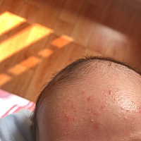 宝宝额头上的是湿疹吗，用什么来搽啊