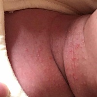 有宝妈知道这是什么吗 孩怎么办 宝宝脖子上好多