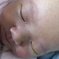 宝宝10天了眼睛里这么多黄色的眼屎怎么回事