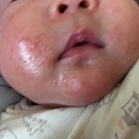 有宝妈知道这是什么要怎么才好啊 看着好急人 涂的东西不管用