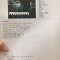 一周前拍的B超跟今天的相比 头长了5mm 股骨长只长了1mm 不会是像爸比是个小短腿吧😂 emmmmm...医生说...