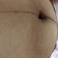 产后19天的肚子，生完宝宝肚子变得好黑，而且怀孕时妊娠线没有这么明显，整个孕期，肚子很大，妊娠纹长...