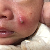 宝宝脸上莫名其妙长了个这个东西，有没有宝妈知道是什么得么？怎么处理，因为是小县城，过年医生没上班...