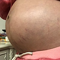 有人用袋鼠妈妈的产品吗？我从三个月开始用她家橄榄油、结果现在才6个多月就这么多妊辰纹