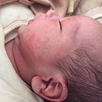 宝宝这几天脸一块块红，怎么回事的呀？