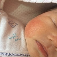 还有一天满月 宝宝脸上又干 还有红血丝 宝妈们知不知道能沫点什么