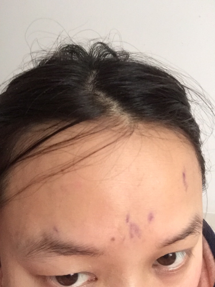 月子21天，今天洗完澡后额头出现这样的紫色是什么原因导致的？有知道的吗？