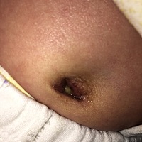 新生儿肚脐脱落了以后底下怎么还有黄色分泌物请问怎么办