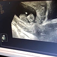 这个白团是啥？做B超是看到胎儿手脚动一下，那个白团在里面翻转