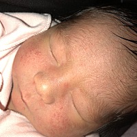 问一下我家宝宝这是湿疹还是痤疮？急死了