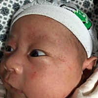 请问下各位宝妈这是热疹还是湿疹，好多天了，反复，都消不下去，有什么妙招吗？，