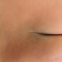 宝宝后背长了一片片的白色皮皮，皮肤不光滑，一开始只在腰部一小片，现在后背好几片了，还有向周围扩展...