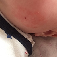 宝宝脸上是口水疹吗？有什么好办法下去呢