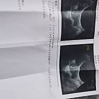 怀孕五周六天，昨天早晨起来有一点褐色分泌物，不多，因为还没做过检查，昨天去了医院抽了血，医生说胎...