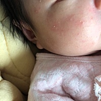 这是湿疹还是什么呀