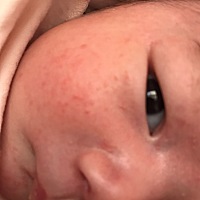 各位宝妈们，最近宝宝起了好多小红点，涂艾维诺的燕麦身体乳都不管用，求方法