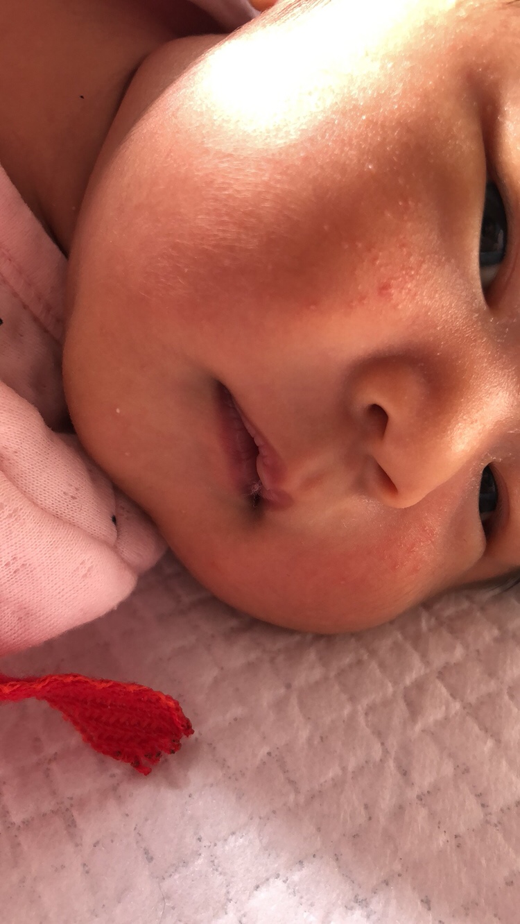 大家帮我看看 13天宝宝脸上长痘痘 还有额头长满了 这个是痱子还是什么