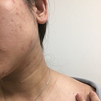 怀孕四个半月了，脸上一直长痘，脖子上还多了好多纹路看着都心烦，怎么办呢？能不能好