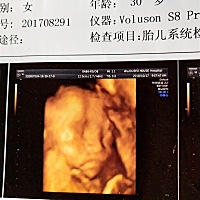 离预产期还有两天，上午破水，中午一点来医院，晚上7:30宝宝就出来了，疼的怀疑人生，见到闺女所有都值...