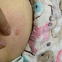 肚皮一处一处地发痒，扣几下就会这样，发红出血点，孕初期，这是怎么回事？抓哪里都这样…有宝妈有相同...