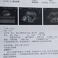 第一胎 今天去检查说都正常 13周多  Nt检查和具体是检查什么项目包括排畸检查吗？其实不太懂看b超图  唐...