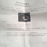 有能看得懂吗？卵巢囊肿影响孩子吗