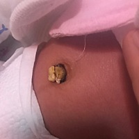 宝宝出生23天了，脐带还没掉，是什么原因？周围发黑的是什么东西，有懂的吗？