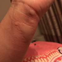 产后荨麻疹已经持续有半个多月了，有相同的宝妈吗？太痛苦了，奇痒无比。有什么解决办法吗？宝宝还吃母...