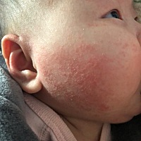 问下宝妈，这个脸上的是不是奶吐出来，没及时擦掉，留在脸上的？宝宝两边巴掌都有…擦了炉甘石也不见好...