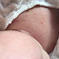 这个是传说中的湿疹嘛？宝宝胸前长了一些，平时领口也比较大感觉也没怎么热着她啊