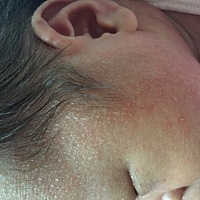 有没有人知道这是什么？需要抱去医院看吗？宝宝额头一片都是但不红，细看有些是透明的，宝宝今天出生第...