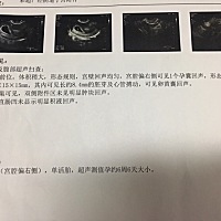 宫内早孕6周6天，第一次做B超，孕囊在宫腔偏右侧，有点担心，后面会自己发展到子宫中间吗？有没有相同的...