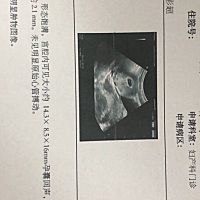 这是单胎还是双？ 有人能看懂吗 ？孕酮怀孕6周孕酮是11.62。是低还是正常？ 下星期测胎心